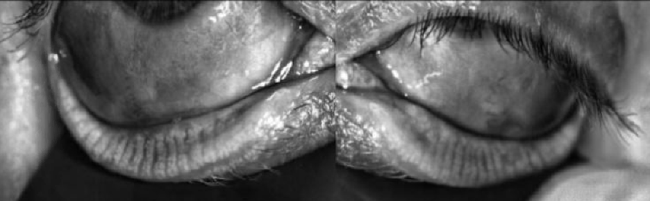 Meibography (LipiView®) demonstrates no meibomian gland atrophy or structural abnormalities in the right lower lid and the left lower lid.