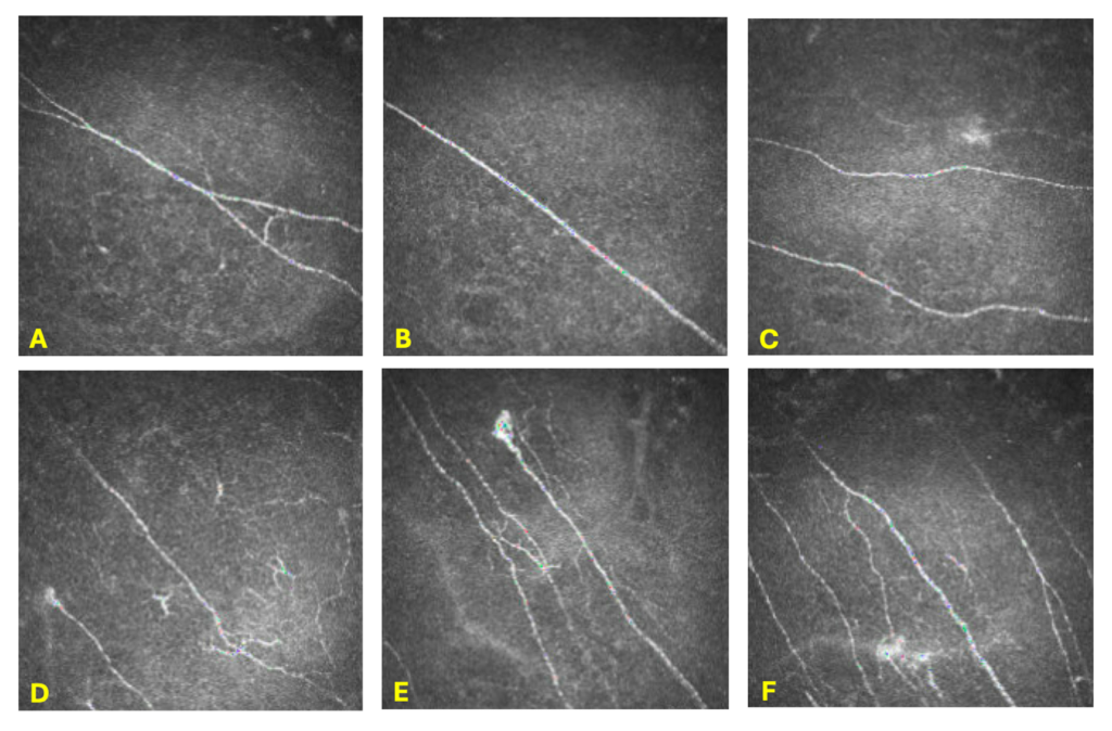 Figure 3. In-vivo confocal microscopy of the corneal sub-basal nerve plexus in the right eye taken with a Heidelberg HRT3. Pictures A-C depict decreased nerve density. Pictures C-F demonstrate microneuromas. Pictures D-F detail nerve tortuosity, nerve beading, and nerve sprouting.