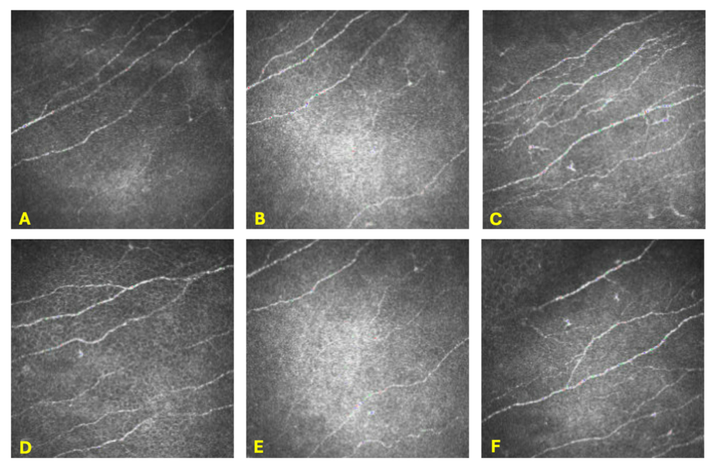 Figure 4. In-vivo confocal microscopy of the corneal sub-basal nerve plexus in the left eye taken with a Heidelberg HRT3. Pictures A-F depict a normal sub-basal nerve plexus. Pictures C and F demonstrate mild Langerhans cells.