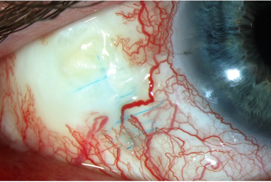 Figure 1. Slit lamp photo of the temporal right eye demonstrating focal scleromalacia perforans, avascular necrosis, deep blue Prolene sutures from RETISERT®, and a calcific plaque. 