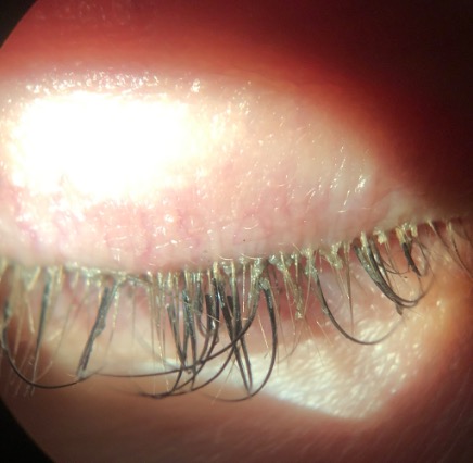 This patient with lash extensions has Demodex blepharitis and loss of lashes nasally where she scratched them out with her fingernail.