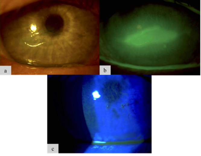 Figure 1. A 68-year-old male patient with chronic DED and diabetes came to the clinic after experiencing several weeks of worsening vision in his right eye (OD). Examination revealed a central epithelial defect (Figure 1a and Figure 1b) and reduced corneal sensitivity, leading to a diagnosis of stage 2 NK. He received two CAMs over 1 week to promote healing, successfully restoring his ocular surface (Figure 1c).
