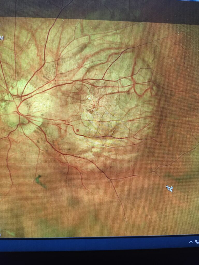 Figure 1. Left eye with staphyloma.Courtesy of Dr. Maria Sampalis