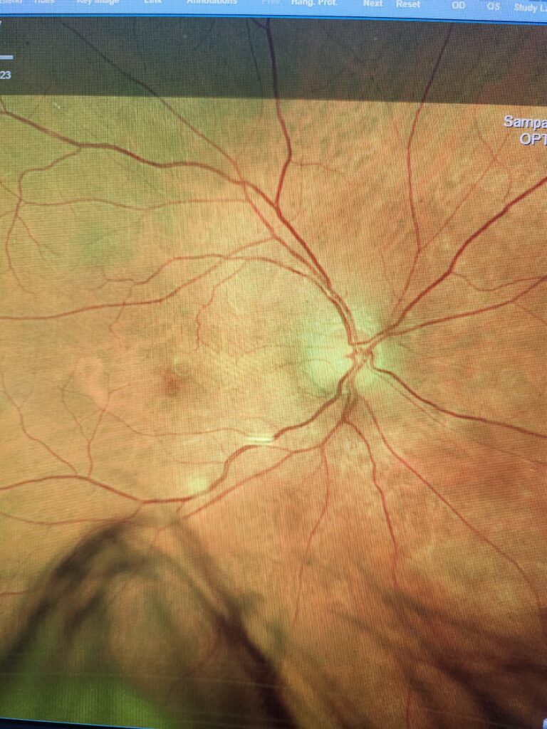 Figure 2. Right eye within normal limits.Courtesy of Dr. Maria Sampalis
