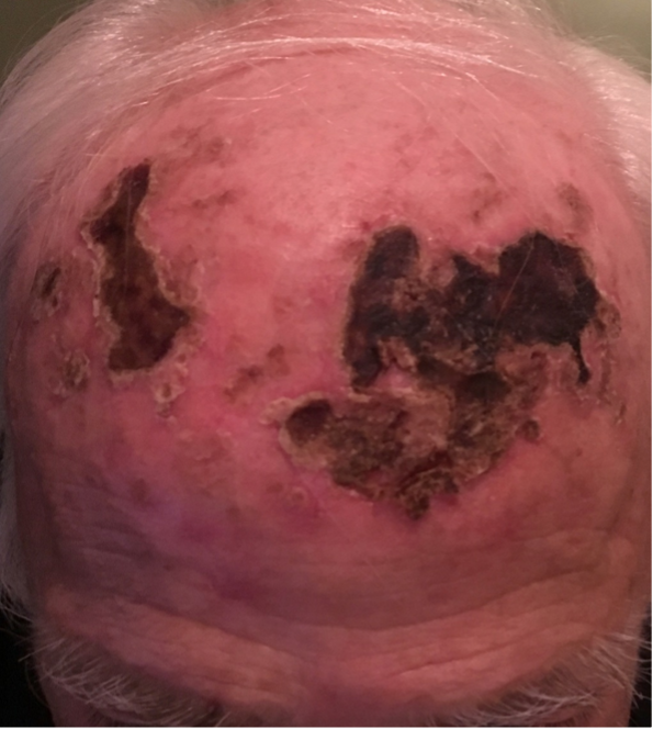 Figure 1. Scabbed lesions that do not respect the midline. Courtesy of Dr. Christopher Kuc
